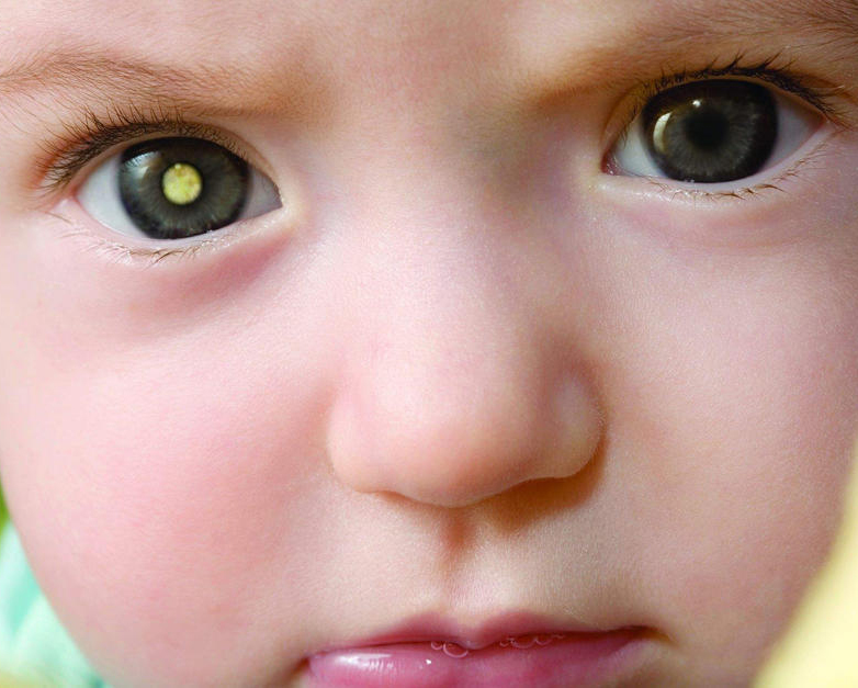 El cancer de ojos en niños se ve con el flash de una fotografía